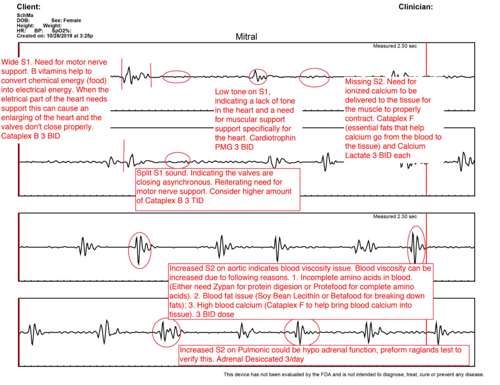 sample graph from heart sound recorder for female patient