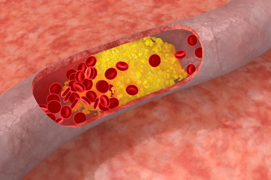 Medications for Cholesterol Treatment